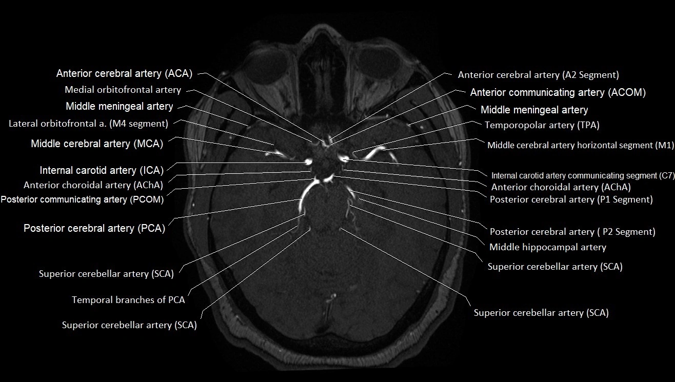 MRA brain (cerebral arteries) anatomy axial 3T image 15.webp